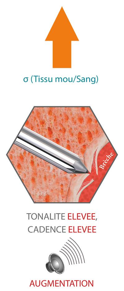 SpineGuard aigu